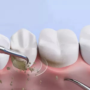 Elektrischer Zahnsteinentferner